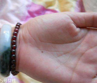 點(diǎn)痣能喝可樂(lè)嗎 這個(gè)可以喝