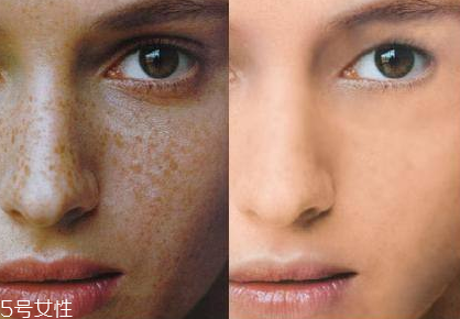 皮秒一次能祛斑干凈嗎 視具體情況而定 皮秒一次能祛斑干凈嗎 視具體情況而定