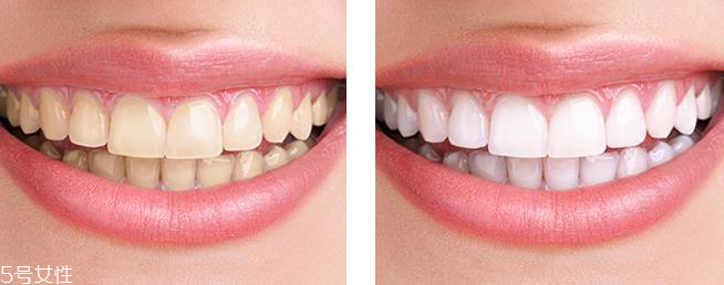 佳潔士美白牙貼有害嗎 不會傷害到牙釉質(zhì) 佳潔士美白牙貼有害嗎 不會傷害到牙釉質(zhì)