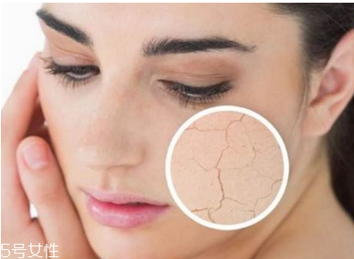 皮膚干燥起皮怎么辦？該如何保養(yǎng)