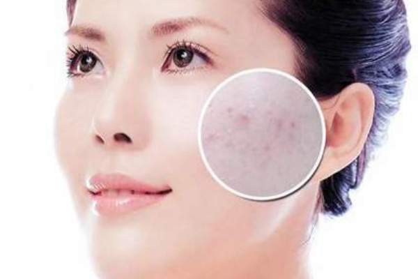 春天為什么總長(zhǎng)痘痘 春天吃這些對(duì)皮膚好 春天為什么總長(zhǎng)痘痘 春天吃這些對(duì)皮膚好