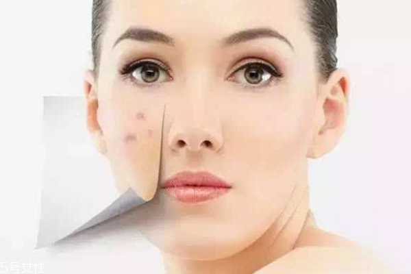 微針去痘印需要注意什么 還你潔白無瑕肌膚 微針去痘印需要注意什么 還你潔白無瑕肌膚