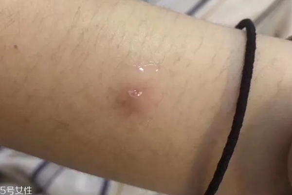 悅木之源祛痘凝膠刺痛什么原因 敏感肌寶寶不適合你 悅木之源祛痘凝膠刺痛什么原因 敏感肌寶寶不適合你