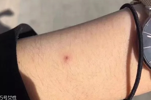 悅木之源祛痘凝膠刺痛什么原因 敏感肌寶寶不適合你 悅木之源祛痘凝膠刺痛什么原因 敏感肌寶寶不適合你