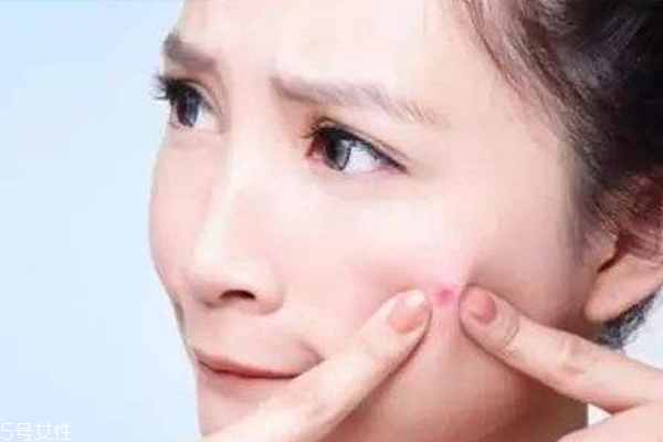什么痘痘不能擠 這種痘擠破一定會留疤 什么痘痘不能擠 這種痘擠破一定會留疤