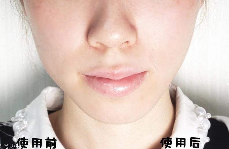 tripollar stop好用嗎 媲美超聲刀 tripollar stop好用嗎 媲美超聲刀