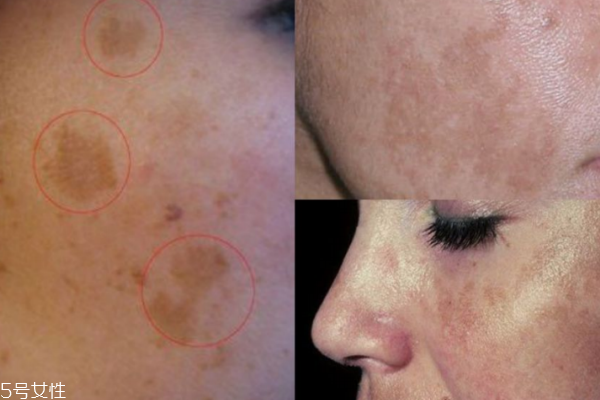 孕斑長什么樣子 3種類型你要知道 孕斑長什么樣子 3種類型你要知道