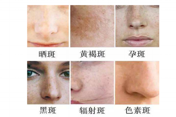 孕斑長什么樣子 3種類型你要知道 孕斑長什么樣子 3種類型你要知道