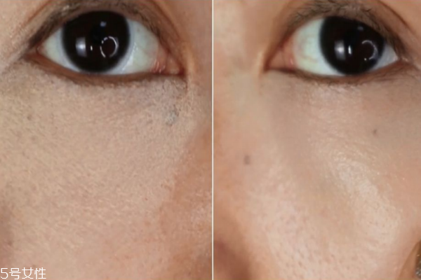 重度淚溝怎么遮瑕 4個(gè)誤區(qū)要避免 重度淚溝怎么遮瑕 4個(gè)誤區(qū)要避免