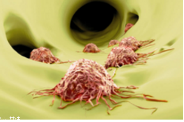 常見癌癥有哪些 生活習慣易引發(fā)癌癥