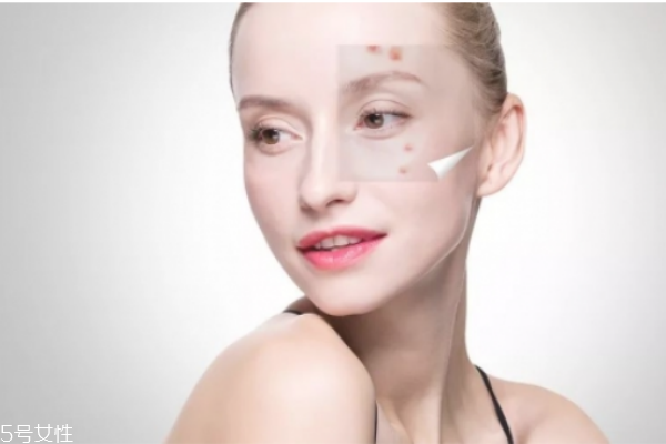 什么皮膚需要去角質(zhì) 深層清潔不是所有人都適合 什么皮膚需要去角質(zhì) 深層清潔不是所有人都適合