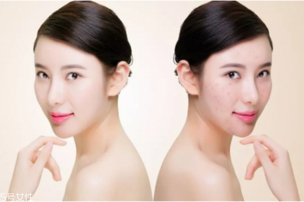 什么皮膚需要去角質(zhì) 深層清潔不是所有人都適合 什么皮膚需要去角質(zhì) 深層清潔不是所有人都適合