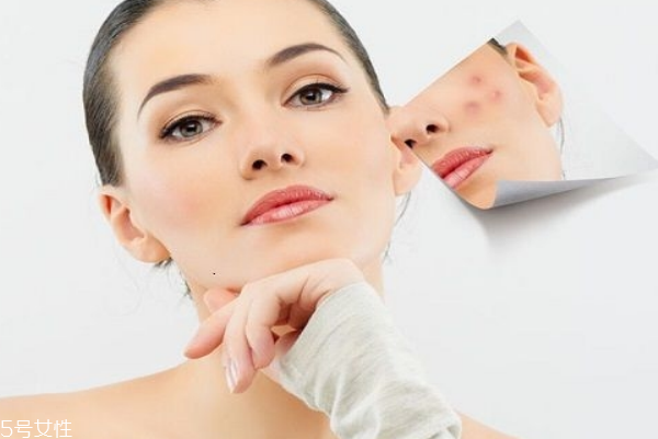 痘痘肌適合用什么護(hù)膚品 這五個(gè)口碑超好 痘痘肌適合用什么護(hù)膚品 這五個(gè)口碑超好