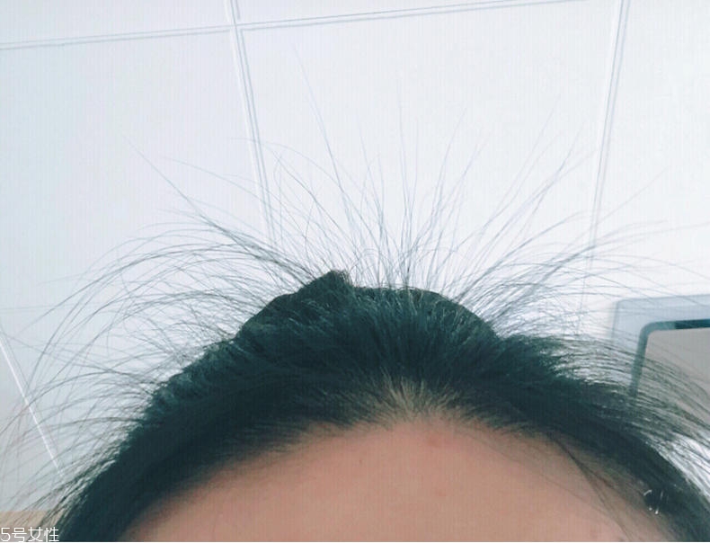 霸王育發(fā)液能生發(fā)嗎 霸王育發(fā)液用了頭癢怎么回事 霸王育發(fā)液能生發(fā)嗎 霸王育發(fā)液用了頭癢怎么回事