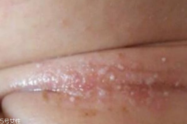 淹脖子是什么 怎么預防 淹脖子是什么 怎么預防