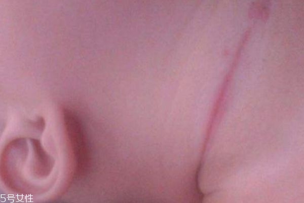 淹脖子是什么 怎么預防 淹脖子是什么 怎么預防