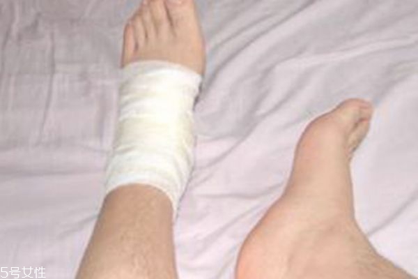 怎么判斷扭傷骨頭 如何治療 怎么判斷扭傷骨頭 如何治療