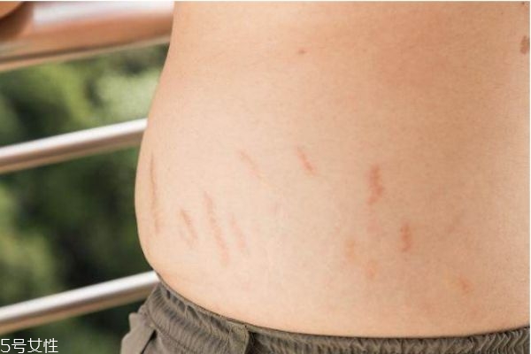 妊娠紋可以祛除嗎 教你怎么預防妊娠紋生長