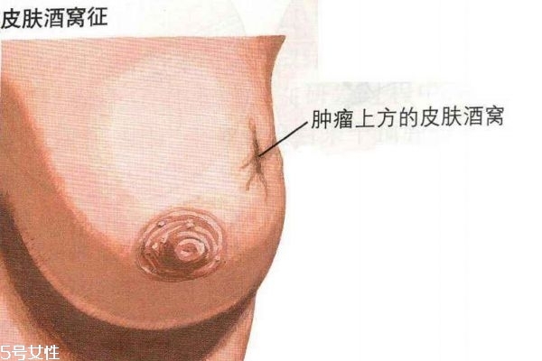 乳腺癌的早期癥狀 帶你認識乳腺癌 乳腺癌的早期癥狀 帶你認識乳腺癌