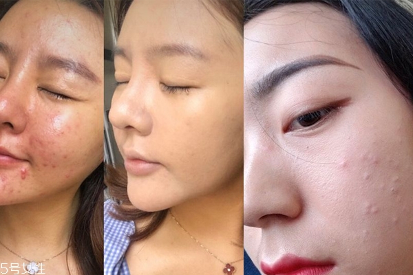 痘痘肌浮粉怎么辦 痘痘肌3個補(bǔ)妝小秘訣