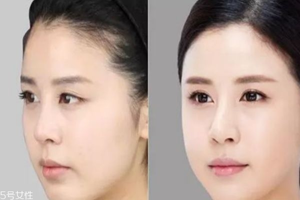 蘋果肌塌陷怎么辦 蘋果肌在哪個(gè)位置