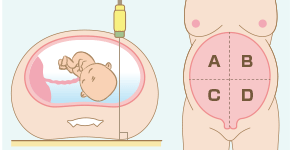 羊水過(guò)多怎么辦 怎么檢驗(yàn)羊水太多或太少