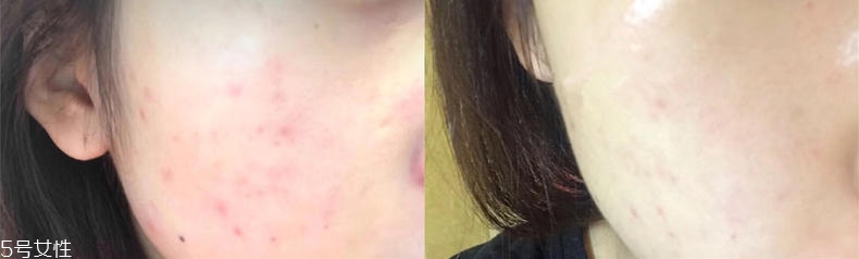 2019醫(yī)美面膜哪個(gè)牌子好 5大熱門醫(yī)美面膜pk 2019醫(yī)美面膜哪個(gè)牌子好 5大熱門醫(yī)美面膜pk