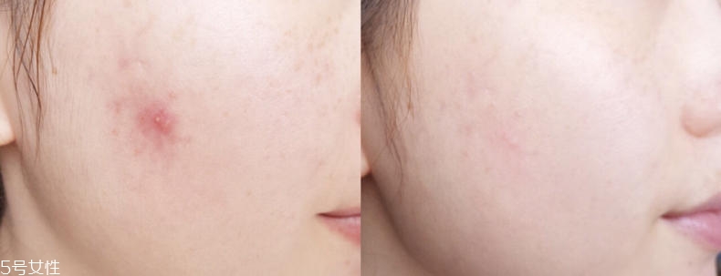 2019醫(yī)美面膜哪個(gè)牌子好 5大熱門醫(yī)美面膜pk 2019醫(yī)美面膜哪個(gè)牌子好 5大熱門醫(yī)美面膜pk