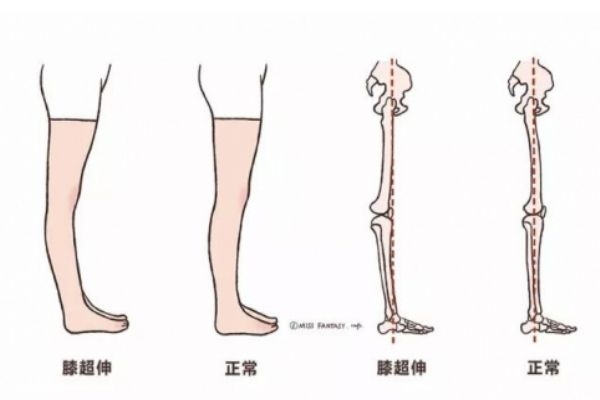 膝蓋超伸怎么矯正 如何正確處理膝超伸