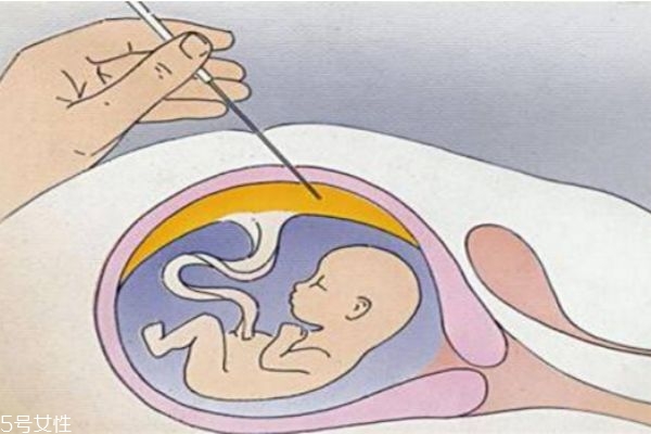 孕婦做羊水穿刺對胎兒有影響嗎 孕婦做羊水穿刺對胎兒有影響嗎