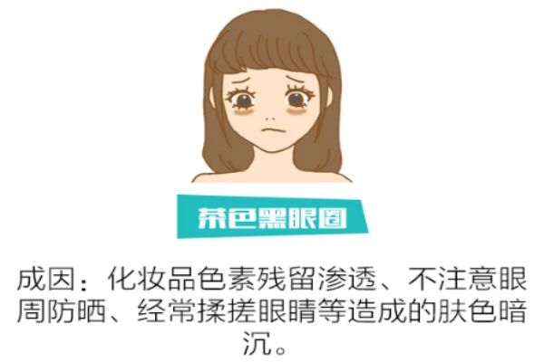 如何分辨黑眼圈類型 找對類型對癥下藥