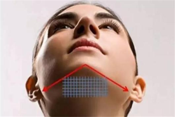 雙下巴可以做線雕嗎 有收緊作用 雙下巴可以做線雕嗎 有收緊作用