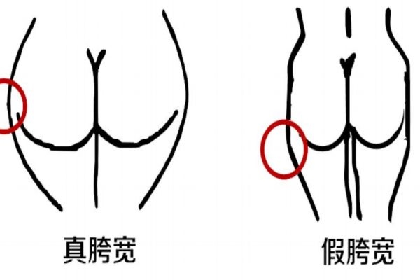 假胯寬是什么意思 自我檢測假胯寬 假胯寬是什么意思 自我檢測假胯寬