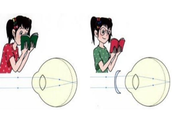 散光是怎么造成的 散光部分癥狀 散光是怎么造成的 散光部分癥狀