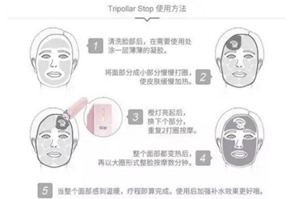 tripollar stop脖子能用嗎 tripollar stop使用時(shí)需注意 tripollar stop脖子能用嗎 tripollar stop使用時(shí)需注意