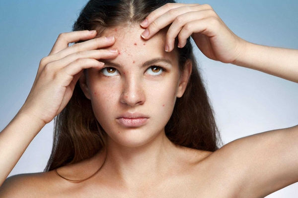 去痘印最有效的方法 愛美的你怎能不學 去痘印最有效的方法 愛美的你怎能不學