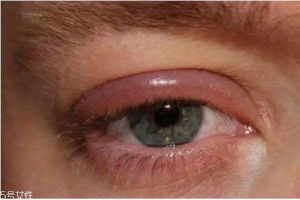 眼睛刺痛是怎么回事 眼睛總是發(fā)癢還有刺痛感 眼睛刺痛是怎么回事 眼睛總是發(fā)癢還有刺痛感