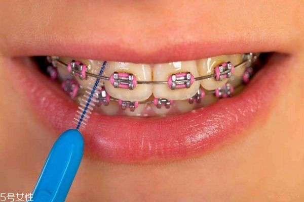 20多歲還能牙齒整形嗎 牙齒整形的最佳年齡 20多歲還能牙齒整形嗎 牙齒整形的最佳年齡