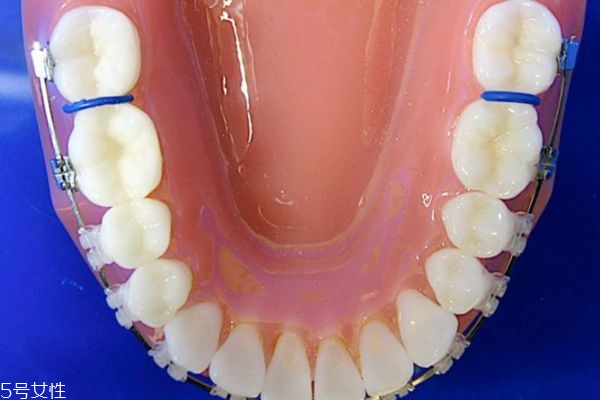 牙齒整形有哪些方法 關于牙齒整形的那些事 牙齒整形有哪些方法 關于牙齒整形的那些事