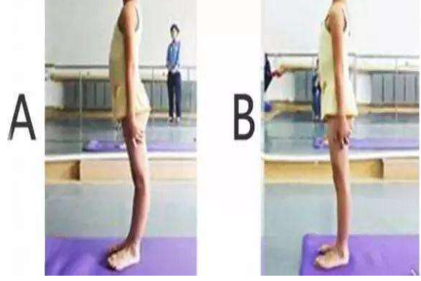 膝蓋超伸可以恢復嗎 可以通過鍛煉改善 膝蓋超伸可以恢復嗎 可以通過鍛煉改善