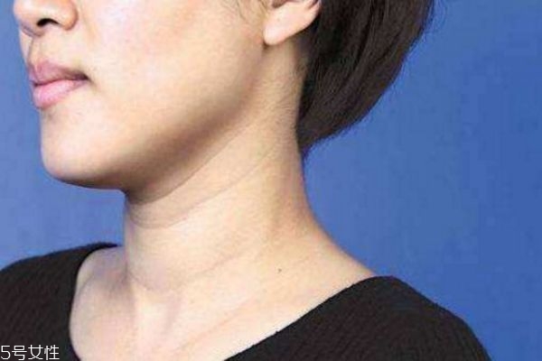 很年輕為什么就有頸紋 頸紋是這樣長(zhǎng)出來(lái)的