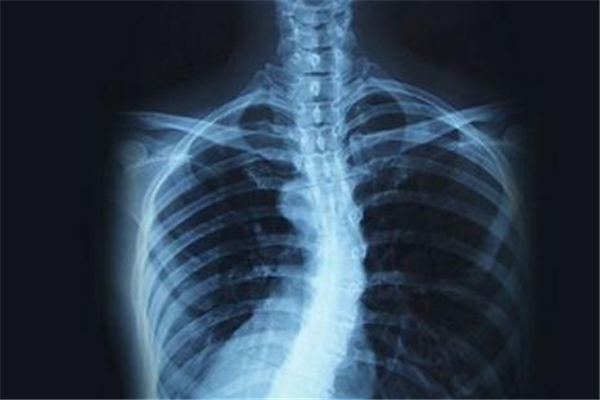 脊椎側(cè)彎造成胸悶、背部疼痛