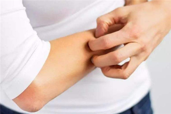 什么是冬季癢 冬季癢預(yù)防之道 什么是冬季癢 冬季癢預(yù)防之道