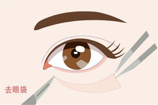眼袋按摩可以消除嗎 眼袋按摩方法 眼袋按摩可以消除嗎 眼袋按摩方法