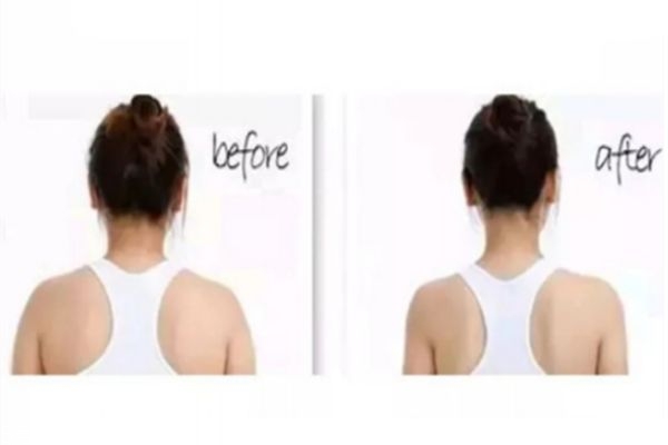 瘦肩針前后對(duì)比照片 瘦肩針注射一定要選擇正規(guī)醫(yī)美 瘦肩針前后對(duì)比照片 瘦肩針注射一定要選擇正規(guī)醫(yī)美