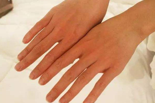 曬傷后如何修復(fù)角質(zhì) 方法是這樣 曬傷后如何修復(fù)角質(zhì) 方法是這樣