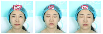 開內(nèi)眼角要多久恢復(fù) 依個人體質(zhì)而定 開內(nèi)眼角要多久恢復(fù) 依個人體質(zhì)而定