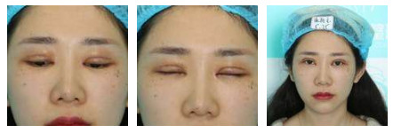 開內(nèi)眼角要多久恢復(fù) 依個人體質(zhì)而定 開內(nèi)眼角要多久恢復(fù) 依個人體質(zhì)而定