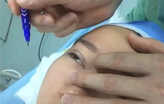 開內(nèi)眼角要多久恢復(fù) 依個人體質(zhì)而定 開內(nèi)眼角要多久恢復(fù) 依個人體質(zhì)而定