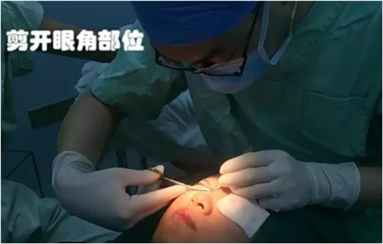 開內(nèi)眼角要多久恢復(fù) 依個人體質(zhì)而定 開內(nèi)眼角要多久恢復(fù) 依個人體質(zhì)而定